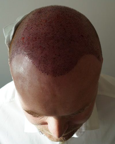 Area implanted during the first hair transplant
