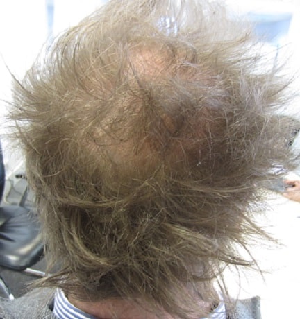 David's donor area before the hair transplants