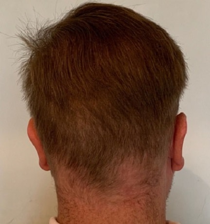 Result of hair transplants on the donor area