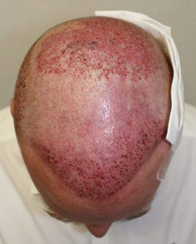 Area implanted with the 3rd hair transplant