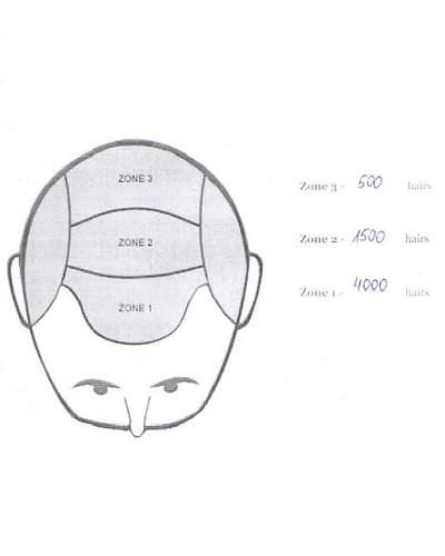 Distribution of hairs in the 1st hair transplant