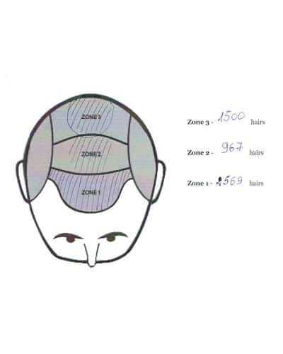 distribution of hairs in the 2nd hair transplant