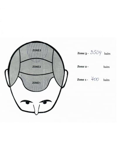 Distribution of hairs in the 3rd hair transplant