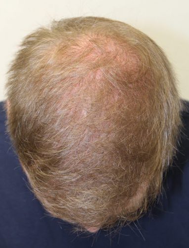 David's hair transplant result - after 2 procedures