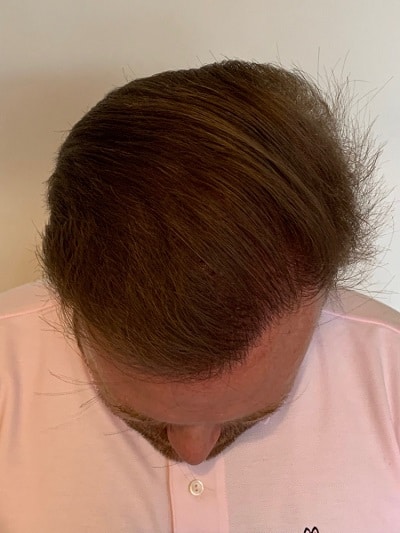 David's final hair transplant result