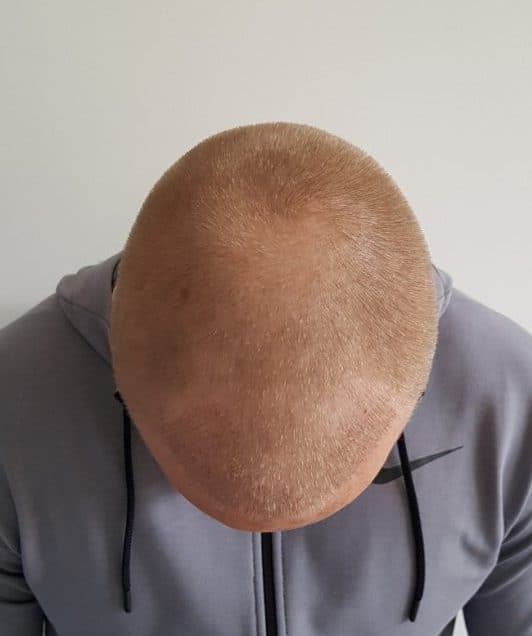 1 week after hair transplant