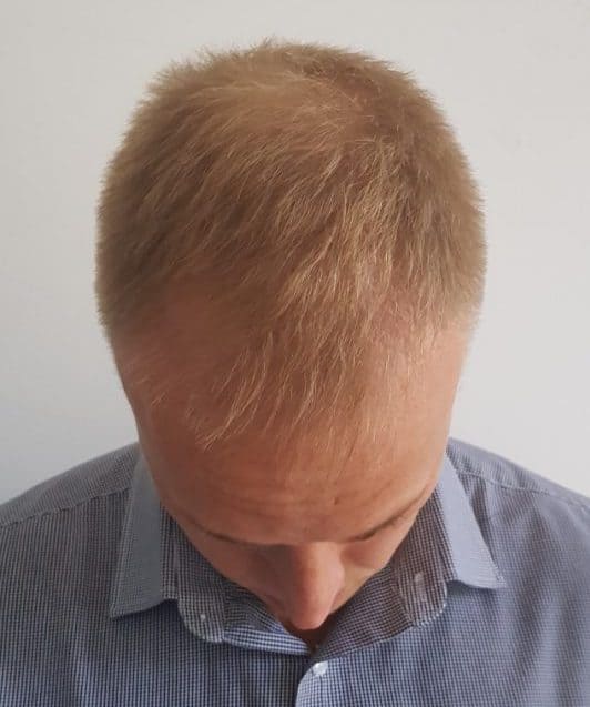 Top of scalp 3 months post-surgery