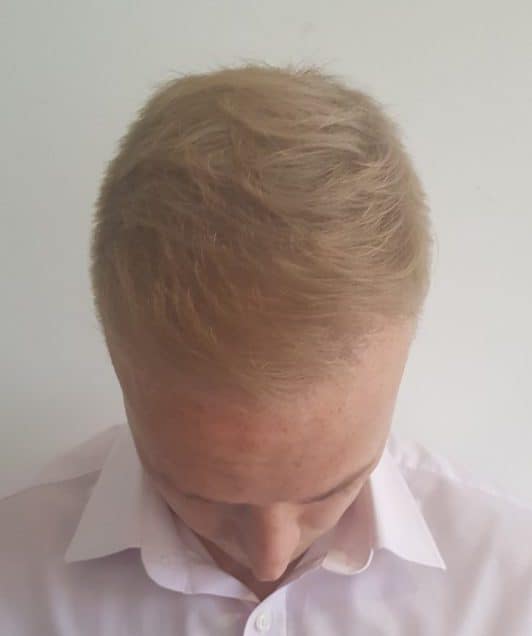 Top of scalp 6 months after surgery