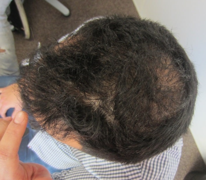 top of head at the consultation before the hair transplant