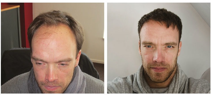 Hair transplantation references - HairPalace