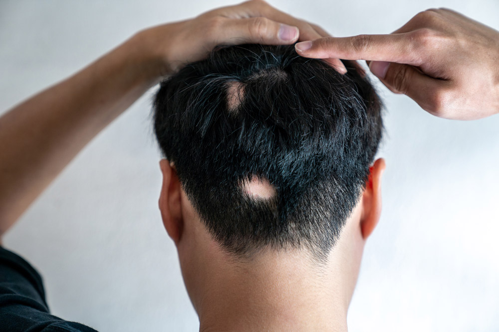 alopecia areata