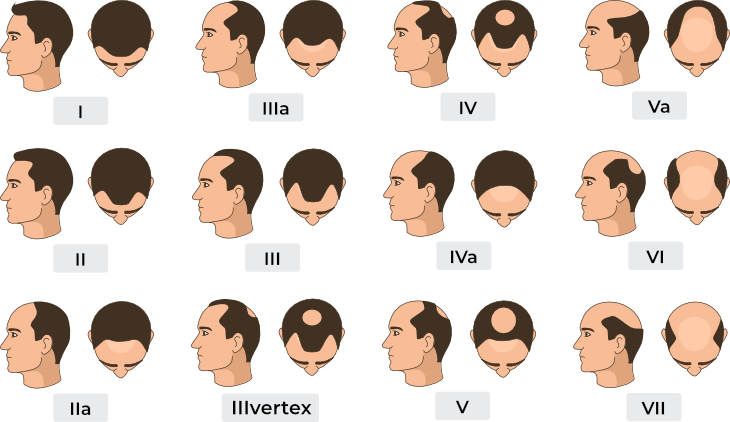 hajbeültetés ár