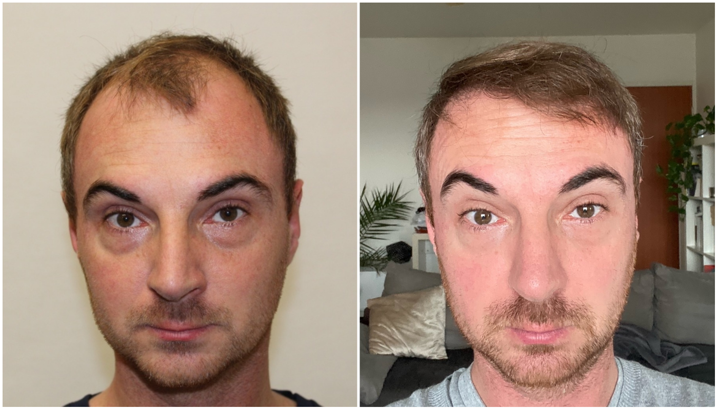 a hajvonal a két hajbeültető kezelést követően