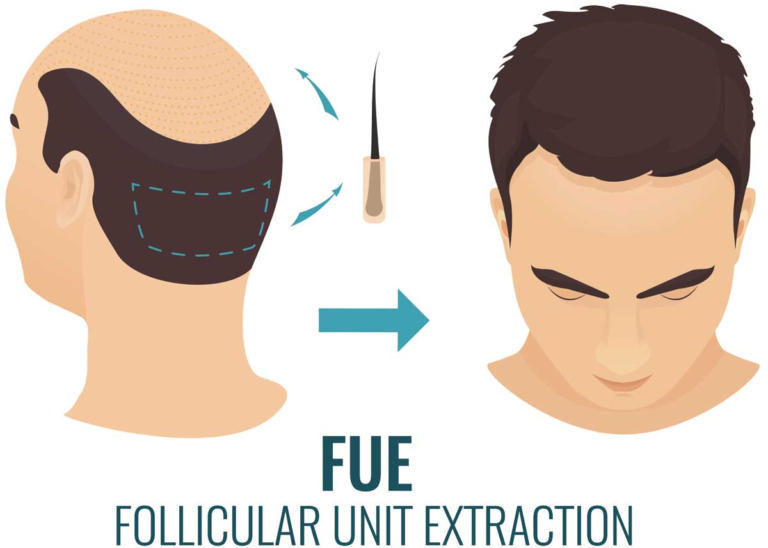 A FUE2 safesystem hajbeültetés módszer