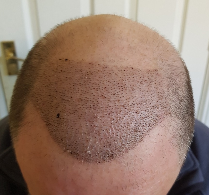 Pörkös fejbőr a hajbeültetés után 1 héttel