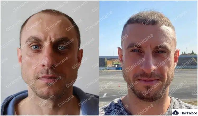 clinicana-hajbeultetes törökország hajbeültetés előtte utána