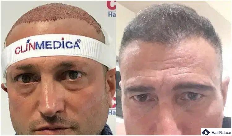 clinmedica-elotte-utana török hajbeültetés eredmény