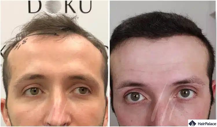 serkan-aygin-clinic törökország hajátültetés eredmény