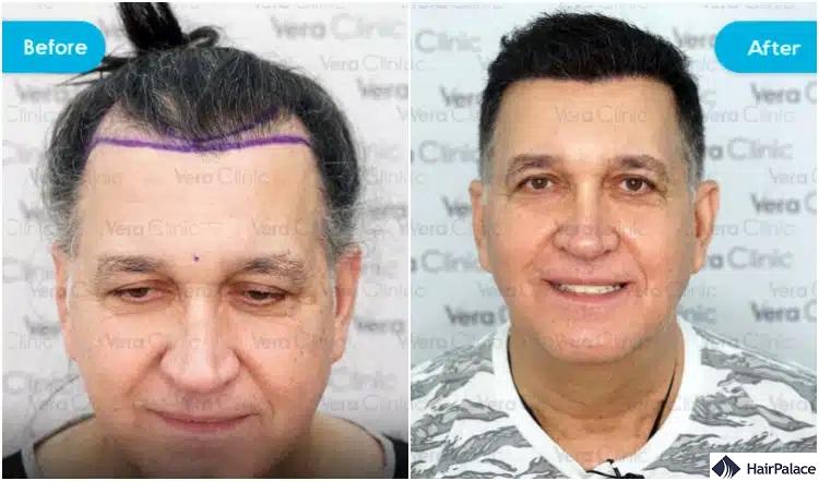 veraclinic-eredmeny török klinika előtte utána