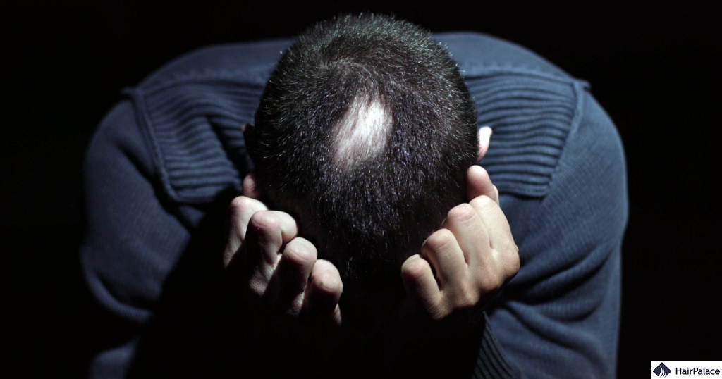 a stressz okozta hajhullás tünetei