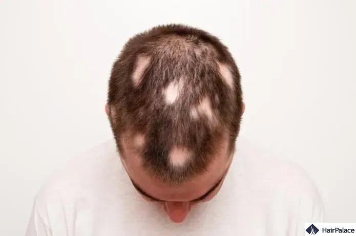 alopecia areata hajvesztés