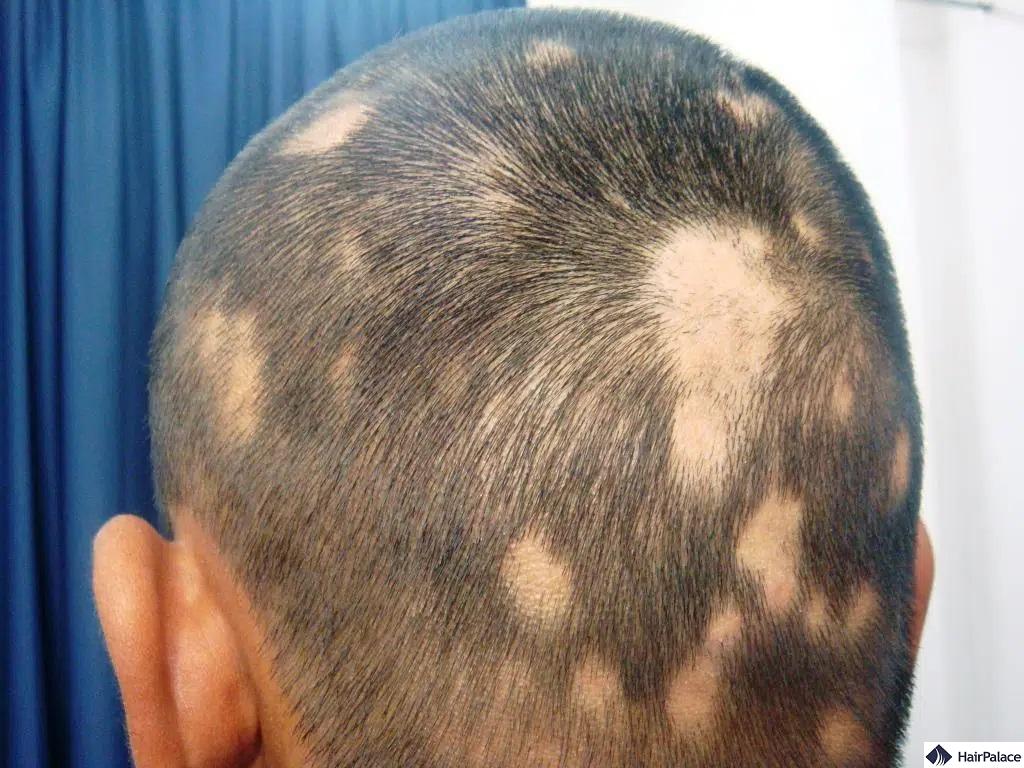 alopecia areata által okozott hajvesztés 