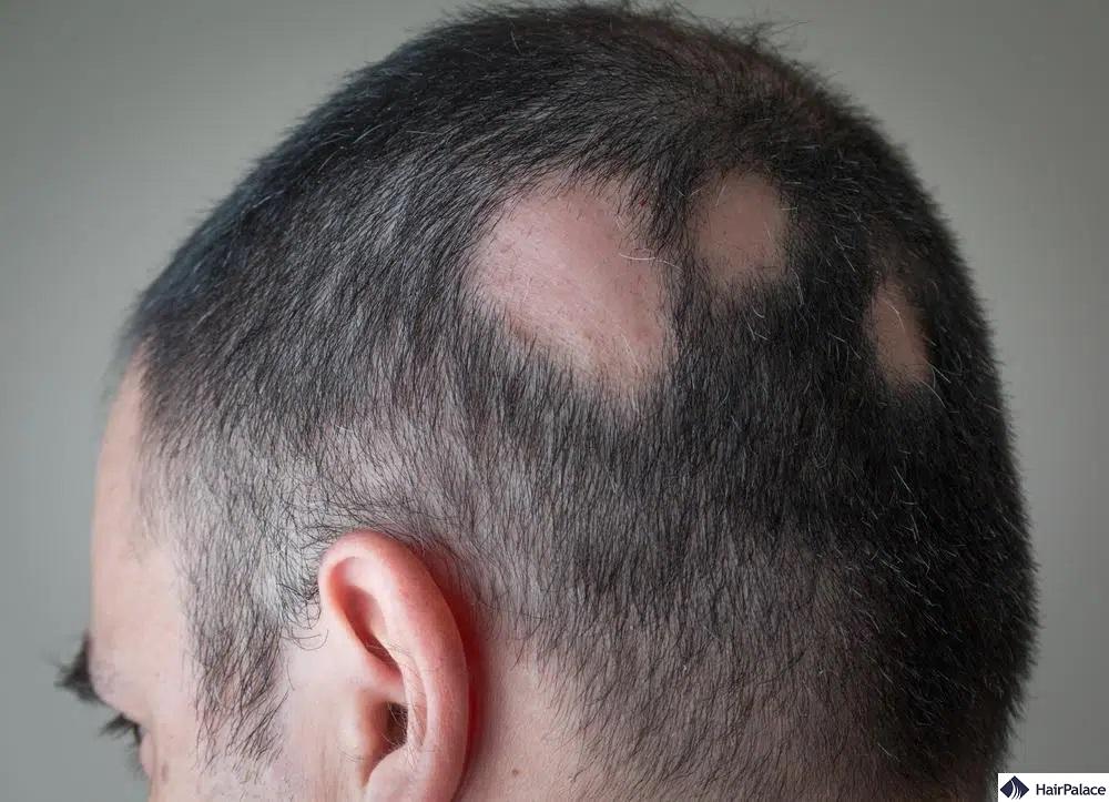az alopecia areata foltos hajhullást okoz