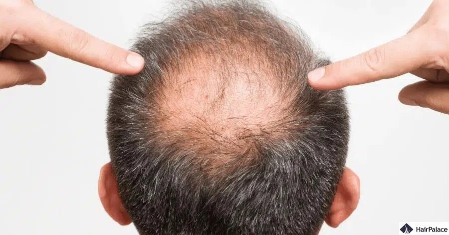 DHT okozta hajhullás okai és kezelése