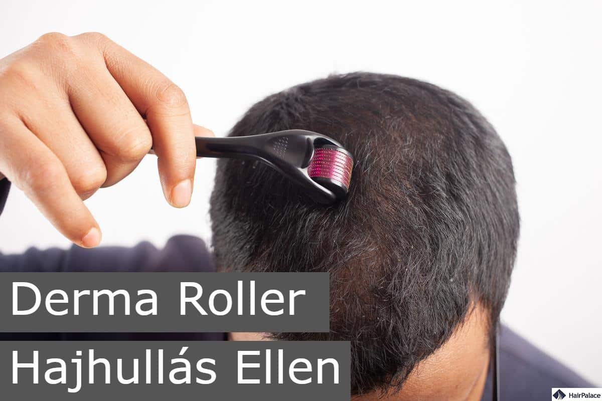 Derma roller Hajhullás Ellen