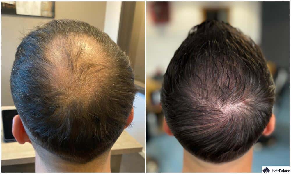 vv leo hajbeültetés eredmény 6 hónap